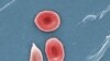 Kasashen Duniya Na Bikin Tunawa Da Ranar Yaki Da Cutar Amosani-Sickle Cell