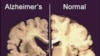 This undated image provided by Merck & Co., shows a cross section of a normal brain (right) and one of a brain damaged by advanced Alzheimer's disease, December 3, 2012.