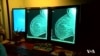New Test May Avoid Unnecessary Chemotherapy